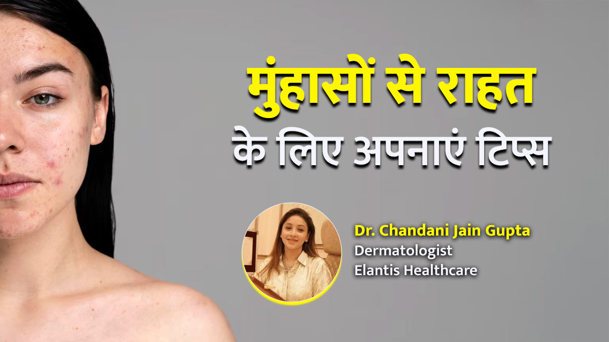 उमस और पसीने के कारण चेहरे पर निकल रहे हैं मुंहासे? डॉक्टर के बताए ये 5 टिप्स आएंगे काम