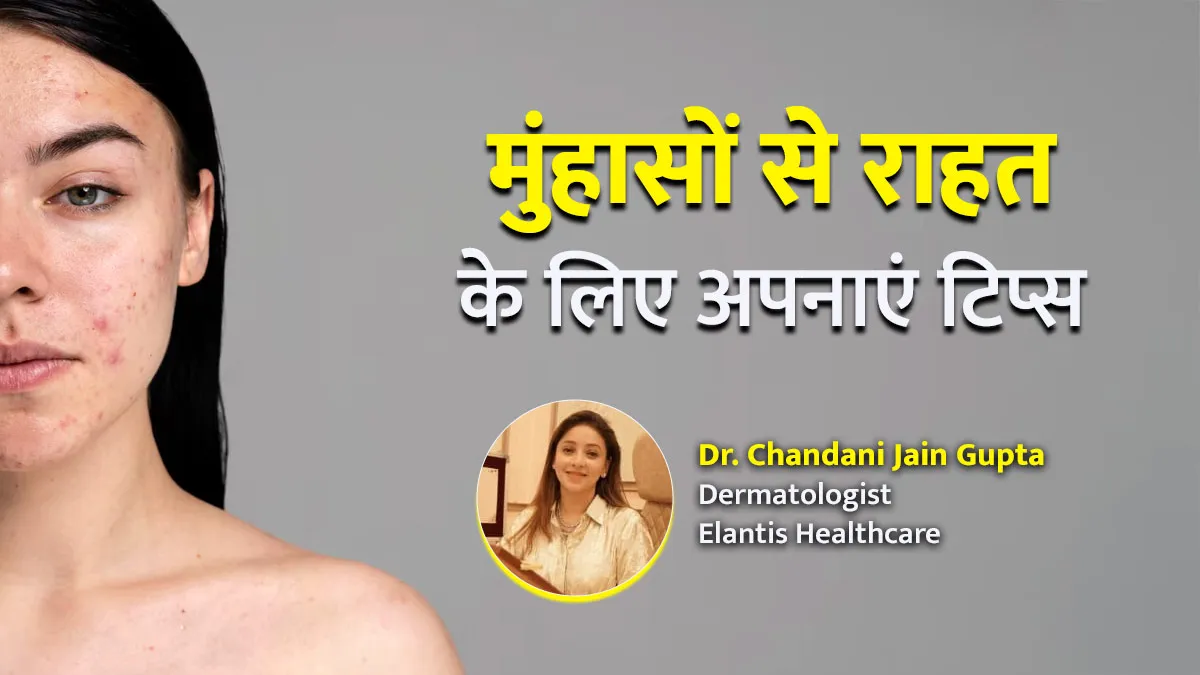 उमस और पसीने के कारण चेहरे पर निकल रहे हैं मुंहासे? डॉक्टर के बताए ये 5 टिप्स आएंगे काम