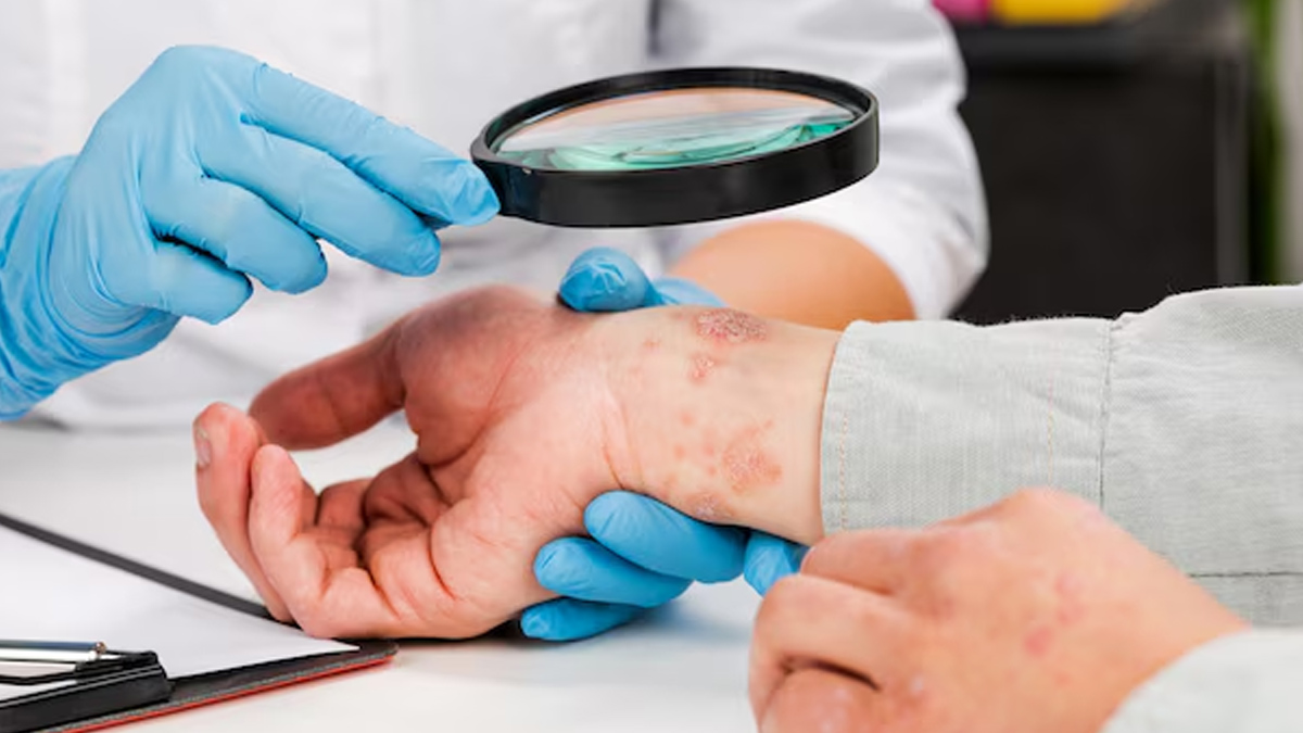 Why does eczema flare up 01 (9)