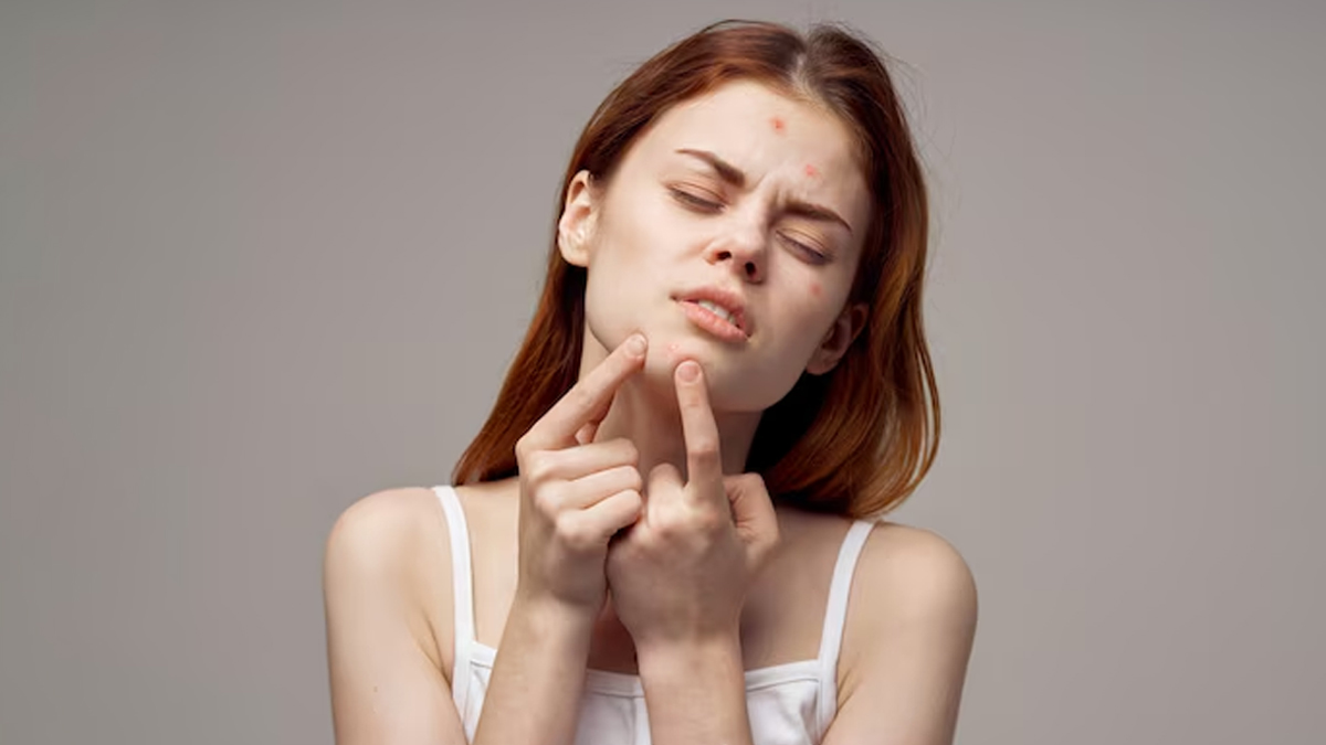 how to prevent acne breakouts in humid weather in hindi 1