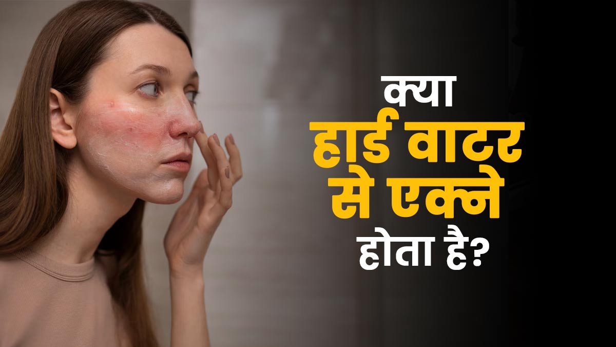 क्या सच में हार्ड वाटर का इस्तेमाल करने से एक्ने होता है? जानें एक्सपर्ट की राय