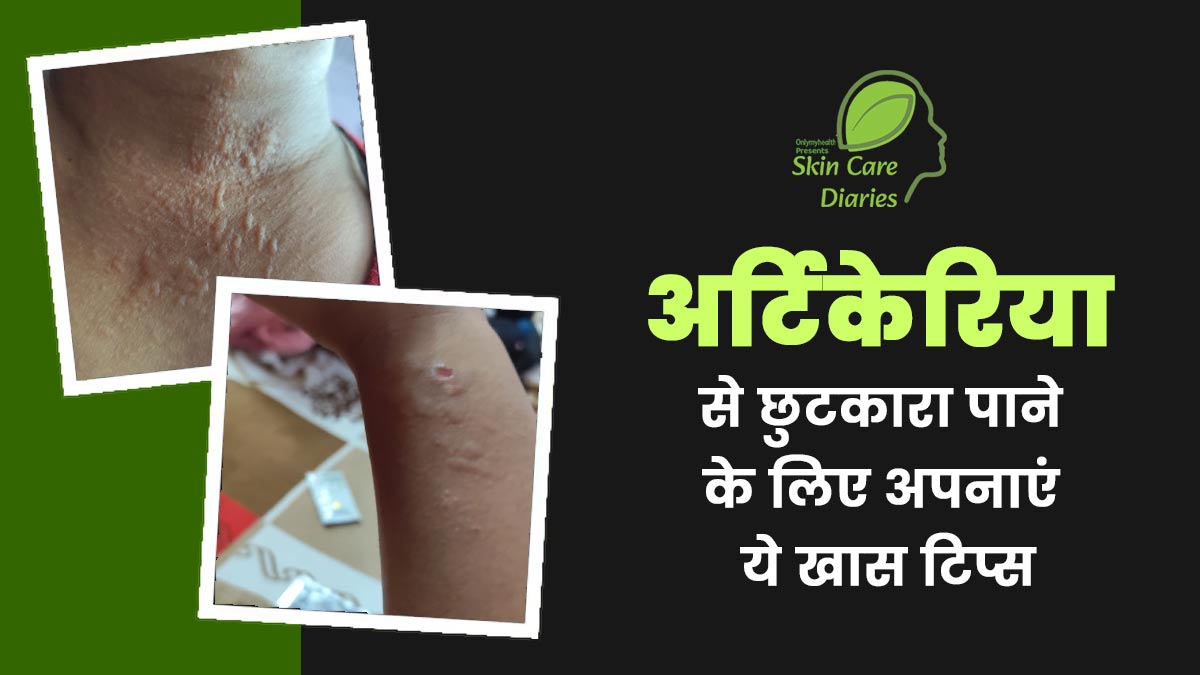 अर्टिकेरिया (पित्ती) से राहत पाने के लिए मैंने अपनाए डॉक्टर के बताए ये 6 टिप्स, सिर्फ एक हफ्ते में दिखा असर