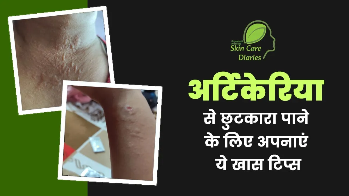 अर्टिकेरिया (पित्ती) से राहत पाने के लिए मैंने अपनाए डॉक्टर के बताए ये 6 टिप्स, सिर्फ एक हफ्ते में दिखा असर