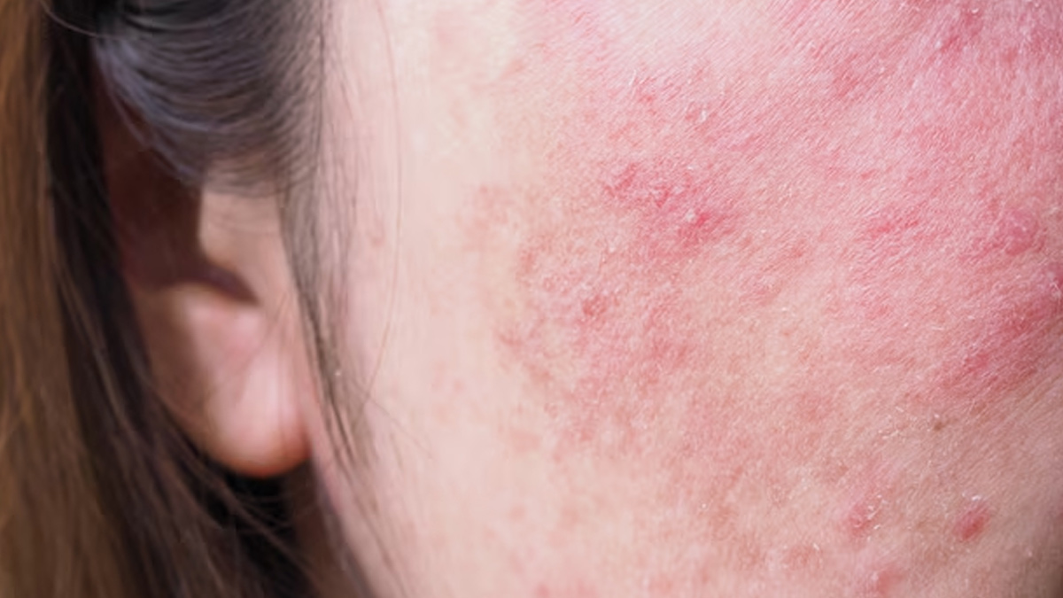 skin-disease-in-monsoon