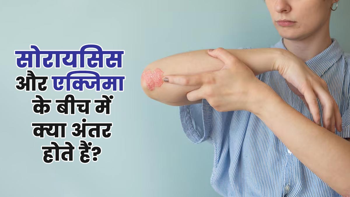सोरायसिस और एक्जिमा के बीच में क्या अंतर होते हैं? डॉक्टर से जानें