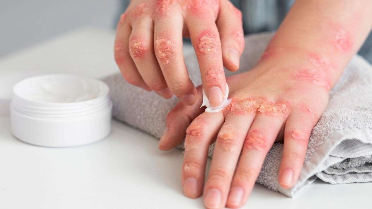 Difference between psoriasis and eczema