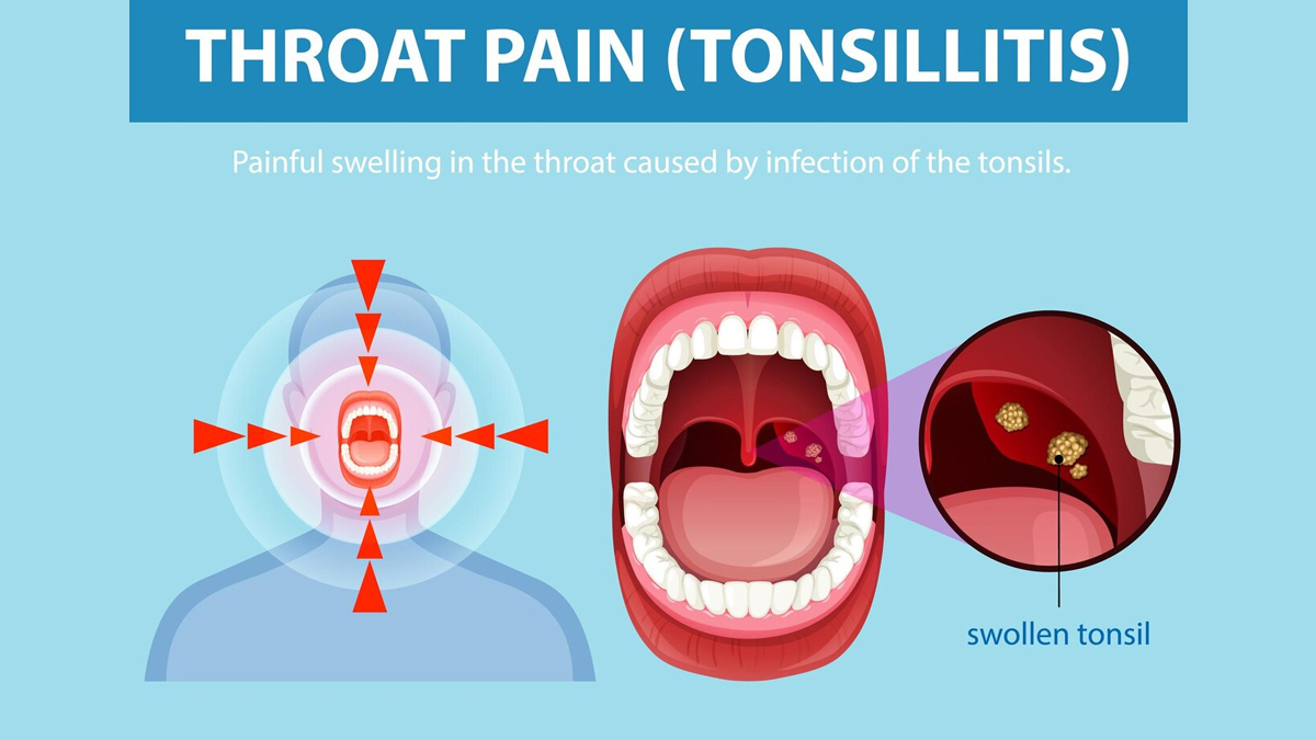tonsils-in-monsoon-prevention-tips