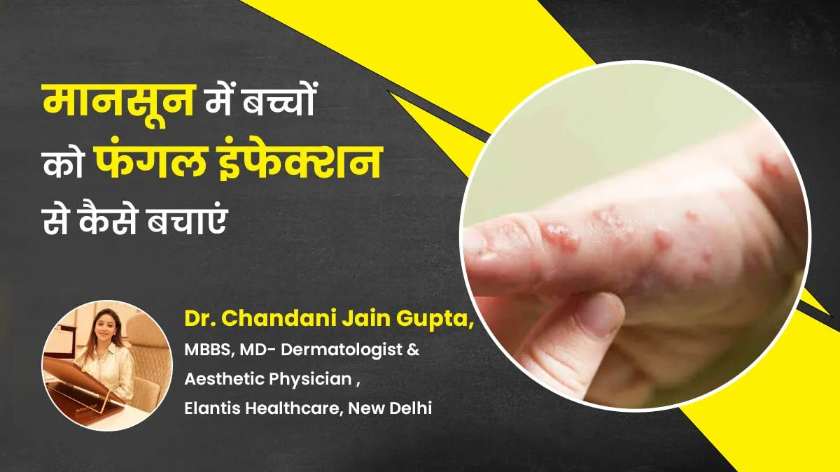 मानसून में बच्चों को फंगल इंफेक्शन से बचाने के लिए अपनाएं ये 5 टिप्स, खुजली और जलन भी होगी कम