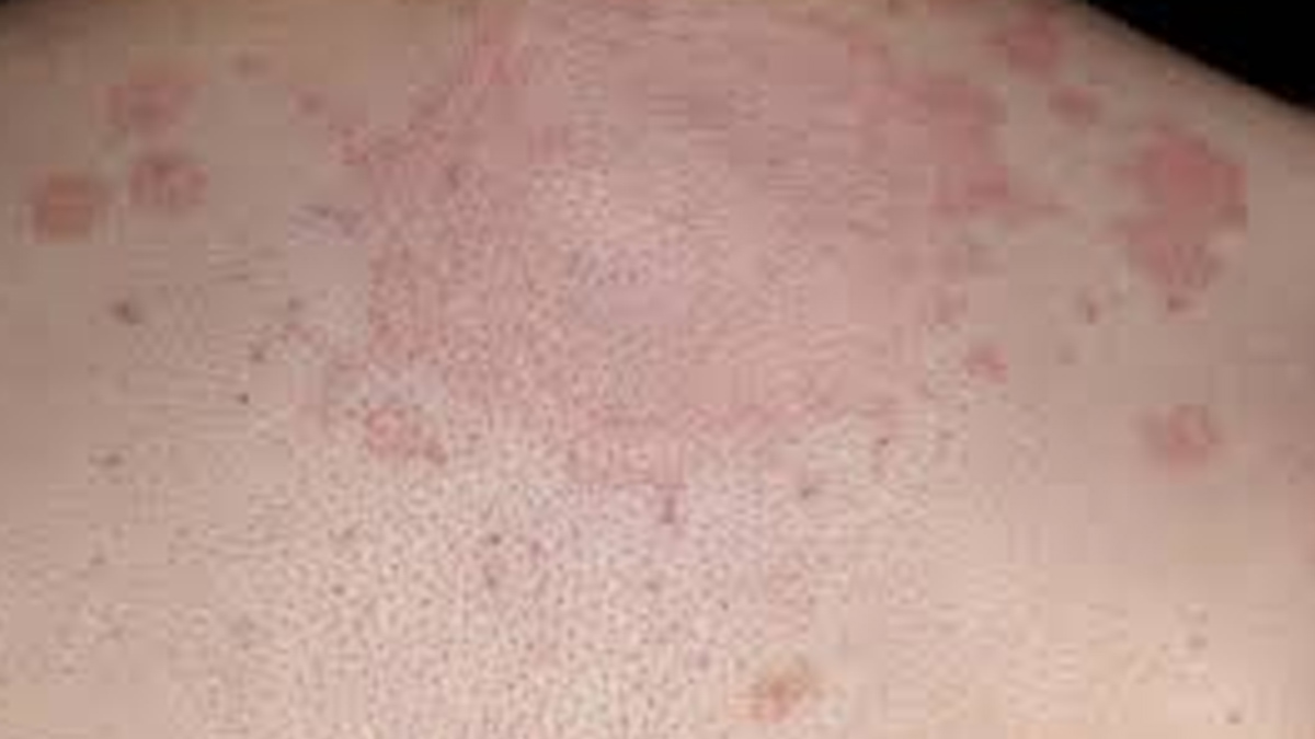 Fungal-infection-inside