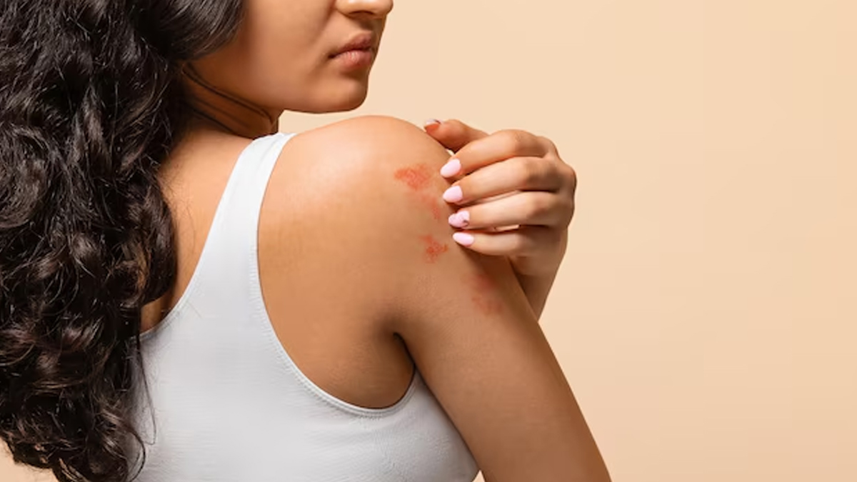 monsoon-humidity-skin-diseases