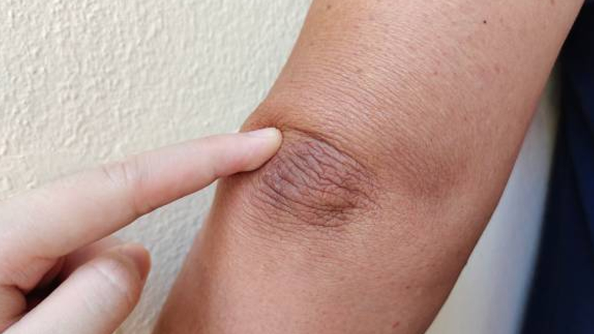 how to use alum to lighten dark elbows at home in hindi 01 (3)