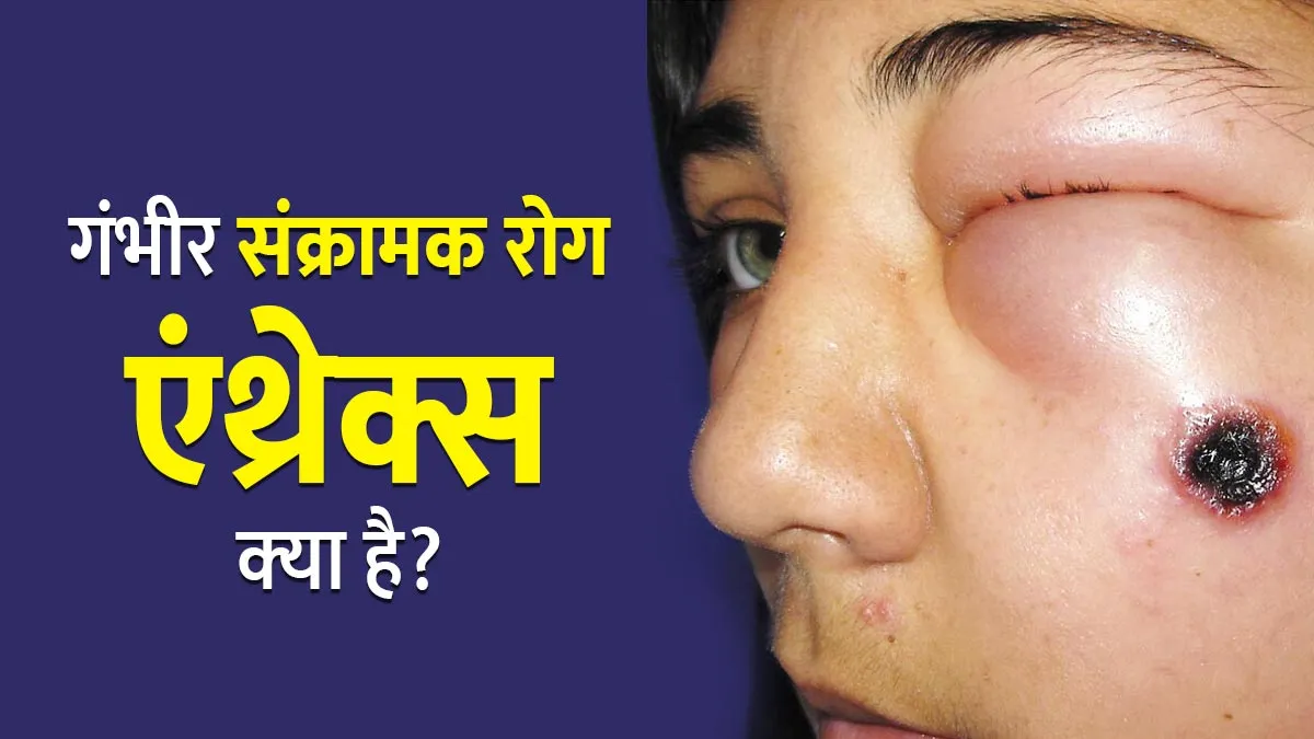जानवरों से फैलने वाला दुर्लभ बैक्‍टीर‍ियल इंफेक्‍शन है एंथ्रेक्स (Anthrax), जानें इसके लक्षण, कारण और इलाज