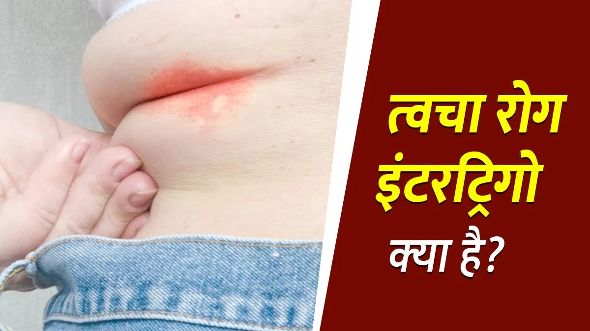 स्किन फोल्ड्स में होने वाला इंफेक्शन इंटरट्रिगो (Intertrigo) क्या है? डॉक्‍टर से जानें लक्षण, कारण और इलाज