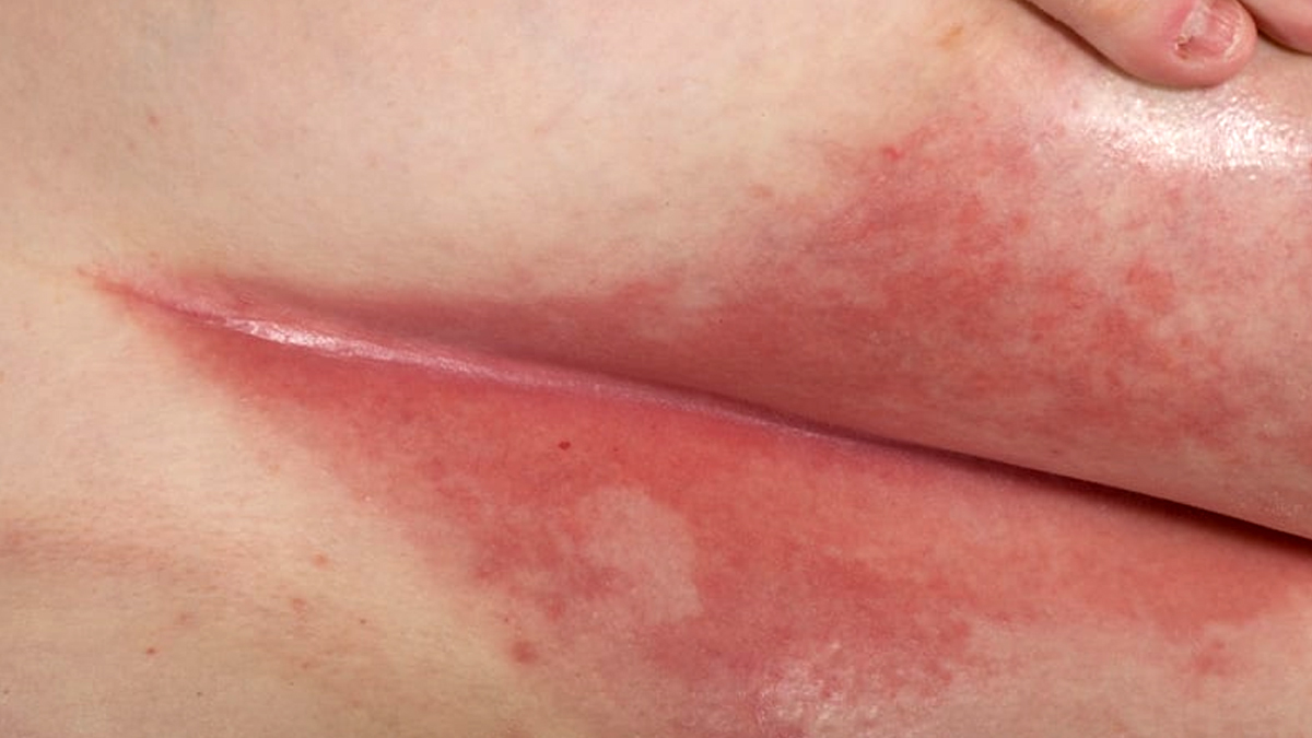 intertrigo-symptoms-causes-treatment