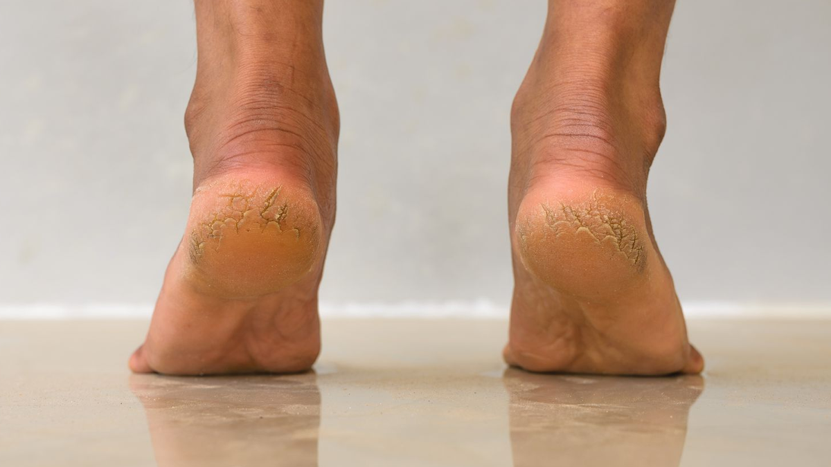 Which-oil-is-best-for-cracked-heels-inside