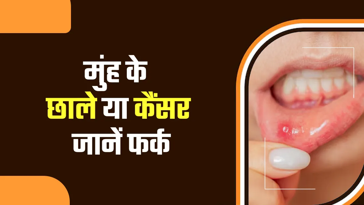 मुंह में लंबे समय से छाले भी हो सकते हैं मुंह के कैंसर का संकेत, डॉक्टर से समझें कैसे पहचानें अंतर