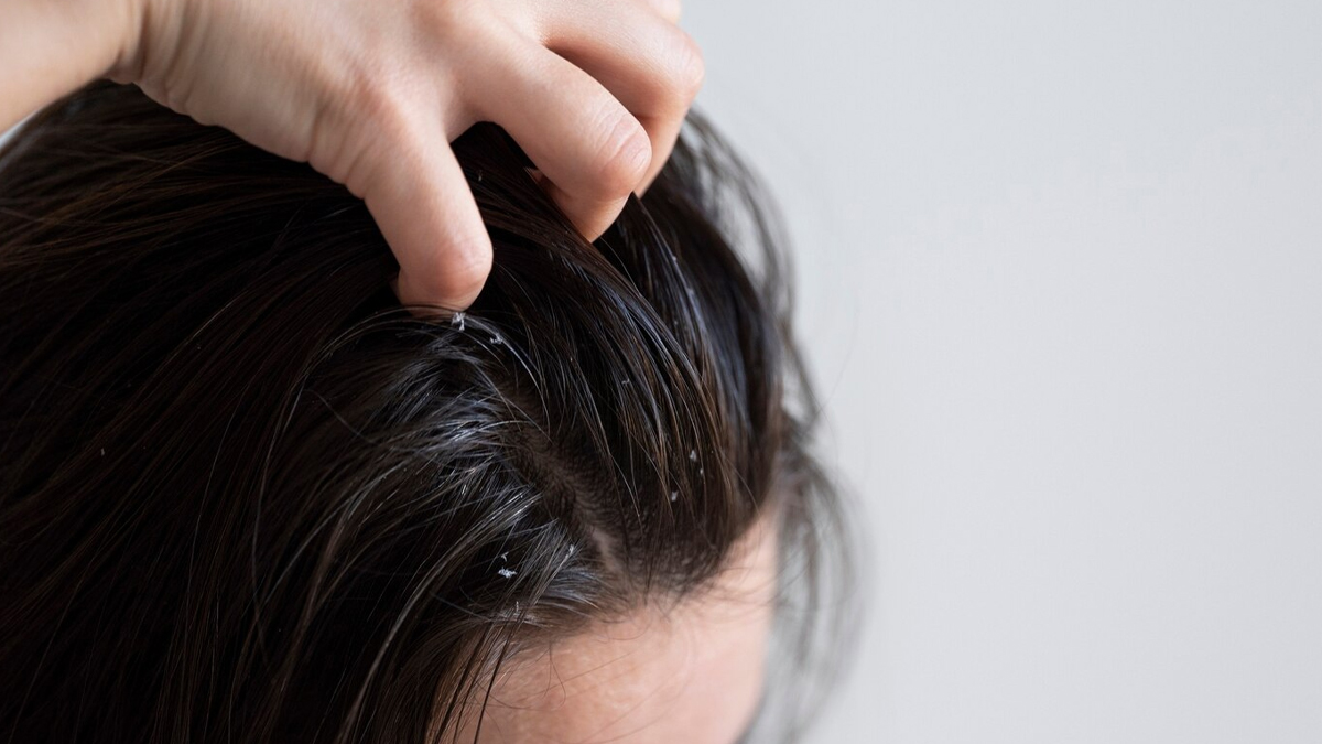 Is buttermilk good for dandruff