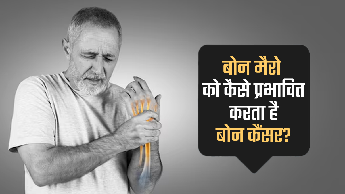 बोन मैरो को कैसे प्रभावित करता है बोन कैंसर? जानें डॉक्टर से