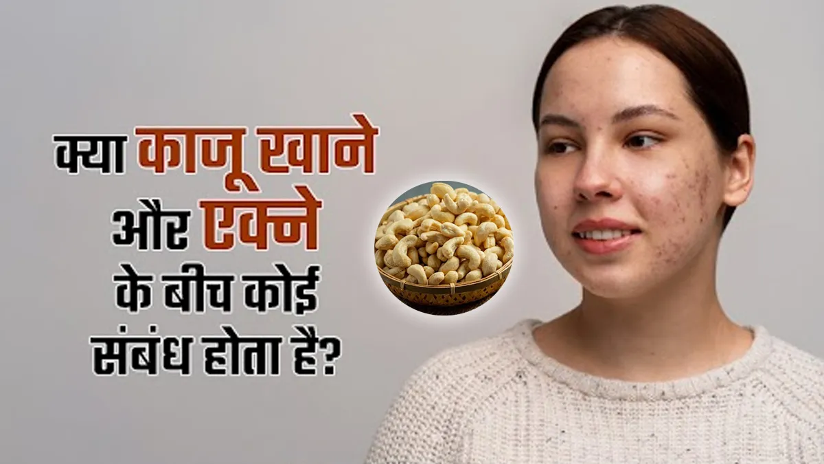 क्या काजू खाने से एक्ने होता है? एक्सपर्ट से समझें क्या है इनके बीच कनेक्शन