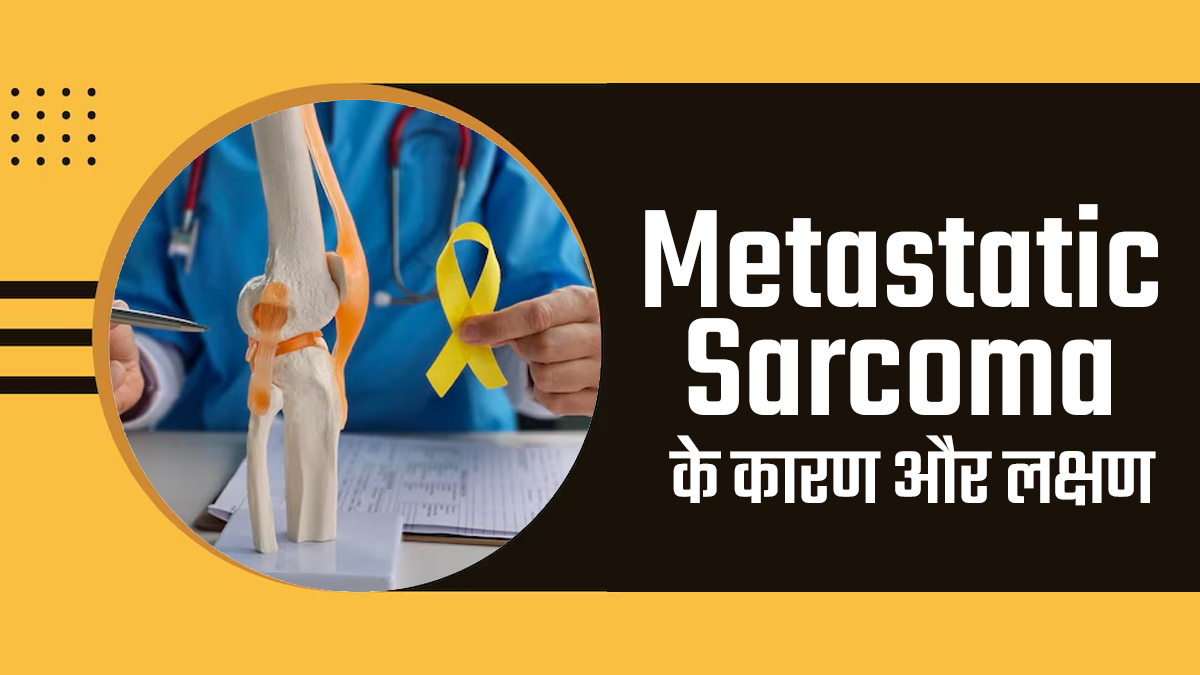 Bone Cancer Awareness Month: मेटास्टेटिक सारकोमा क्या है? डॉक्टर से जानें क्या है इसके कारण और लक्षण