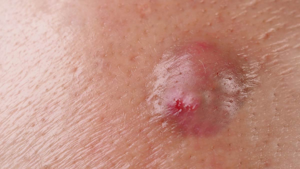 बालतोड़ का इलाज क्या है | baltod ka ilaj baltod-inside