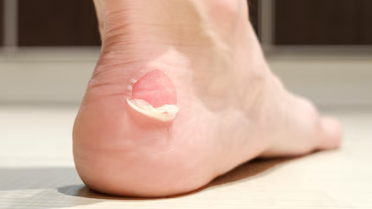 foot_disease