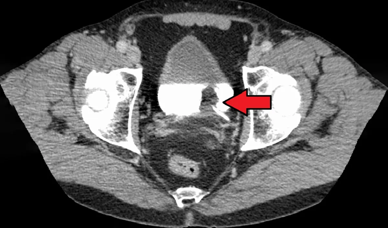 bladder-cancer-inside