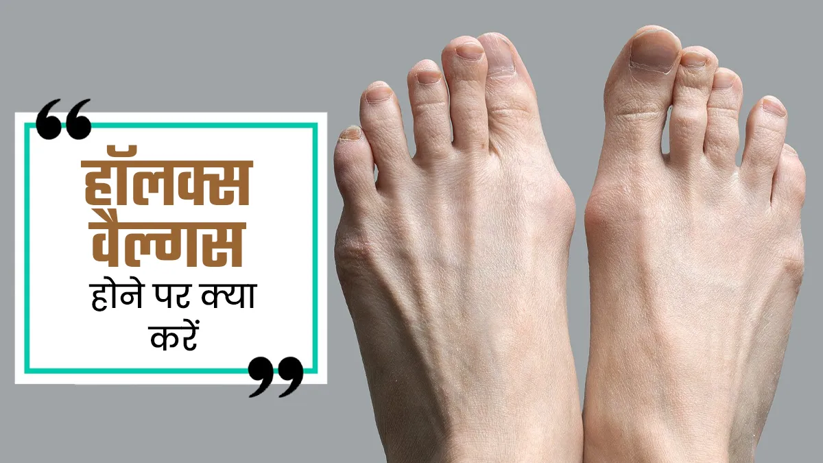 नॉर्मल लगने वाला पैरों का दर्द हो सकता है हैलक्स वैल्गस, डॉक्टर ने बताया इसमें क्या करें और क्या नहीं