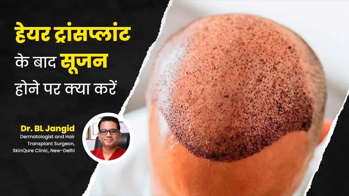 हेयर ट्रांसप्लांट कराने के बाद सिर में आ गई सूजन? जानें इस स्थिति में क्या करें और क्या नहीं