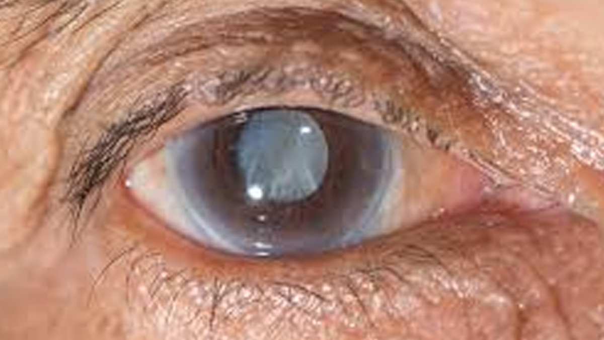 क्या मोतियाबिंद का इलाज बिना ऑपरेशन संभव है | Can Cataract Be Treated Without Surgery | Motiyabind ka ilaaz kya hai Cataracts-insidee