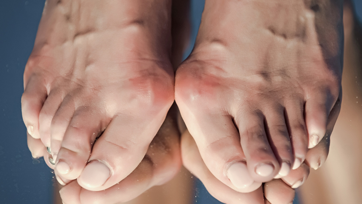 hallux-valgus-inside