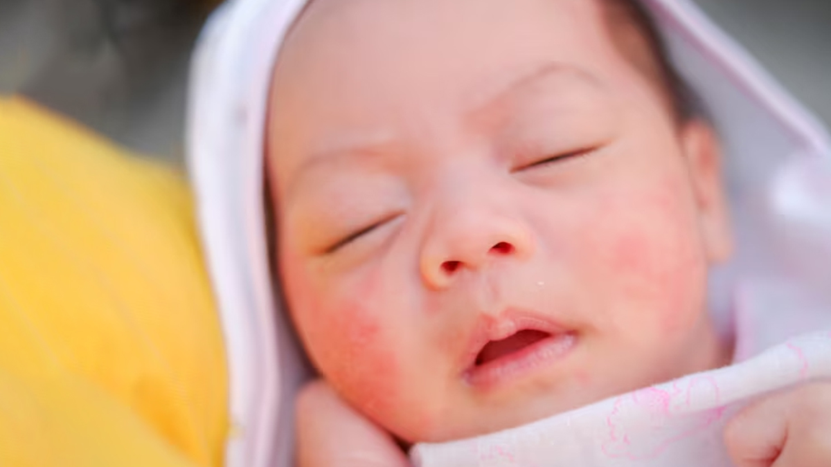 viral-infection-in-babies