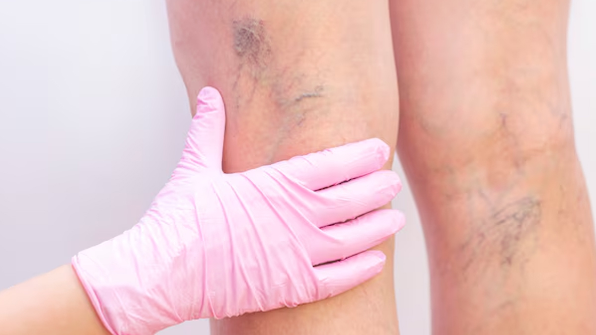 Chronic Venous Insufficiency in