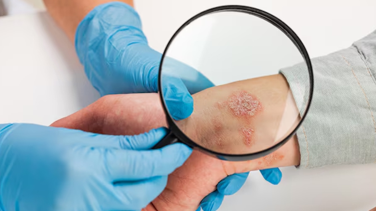 Health Problems That Can Be Linked To Psoriasis in