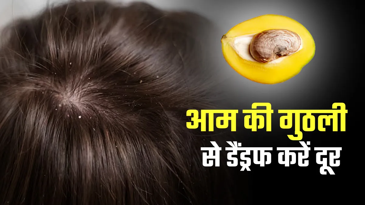 डैंड्रफ हटाना है तो शैंपू नहीं, अपनाएं आम की गुठली का देसी नुस्खा! एक्सपर्ट से जानिए