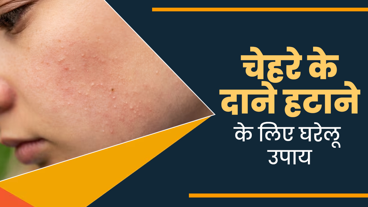 चेहरे के छोटे-छोटे दानों से हो गए हैं परेशान? छुटकारा पाने के लिए अपनाएं ये 5 घरेलू उपाय 
