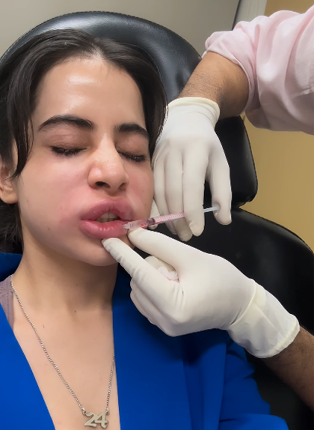 Urfi-javed-lip-fillers