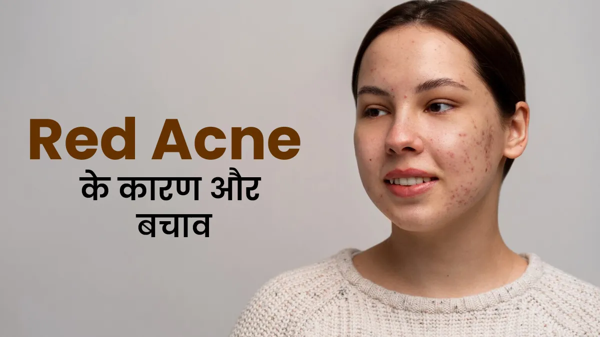 क्या आपको भी है रेड एक्ने की प्रॉब्लम? डॉक्टर से जानें इसके कारण और बचाव के तरीके
