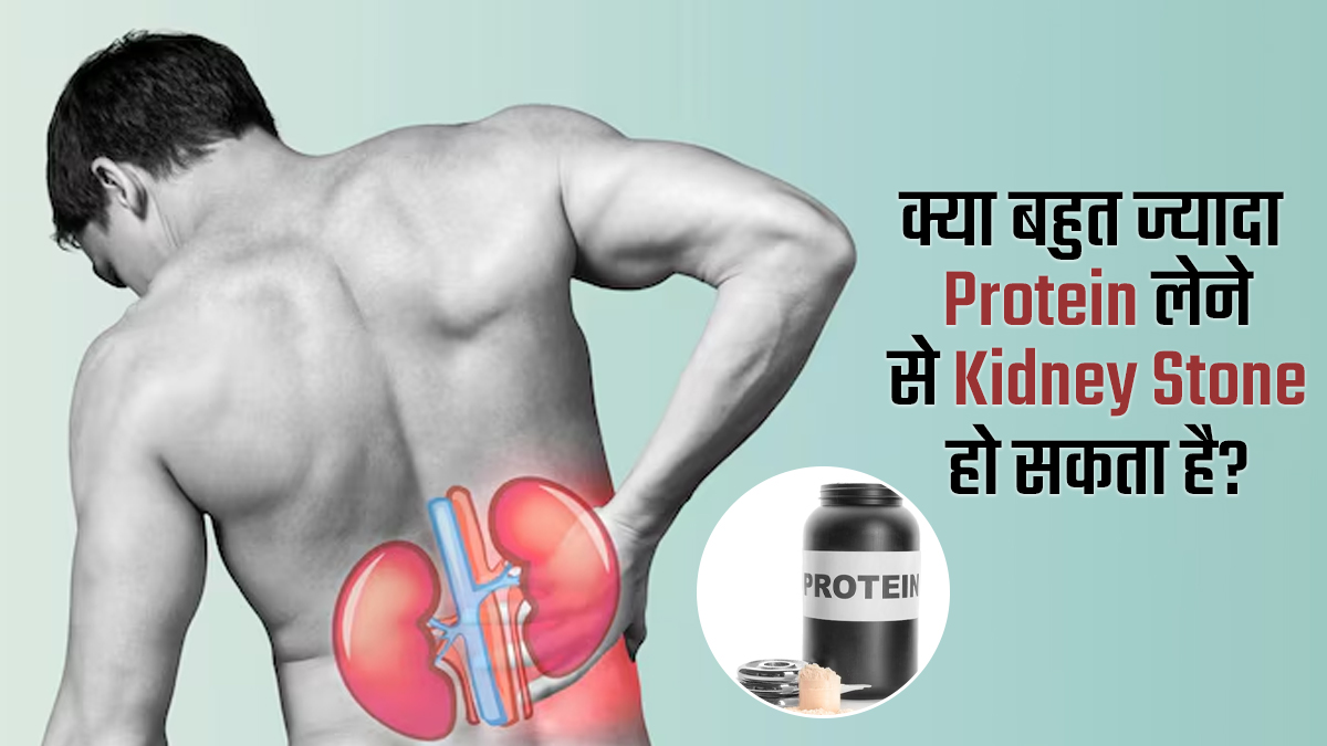 क्या बहुत ज्यादा प्रोटीन लेने से किडनी स्टोन हो सकता है? डॉक्टर बता रहे हैं सच्चाई