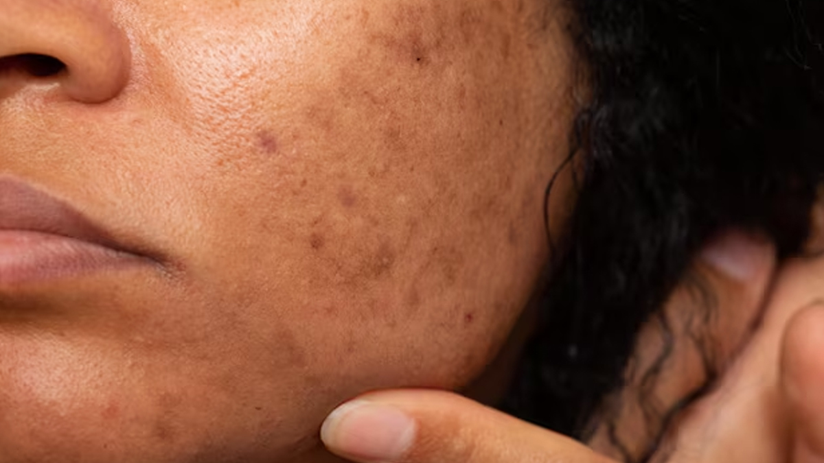 can vitamin d deficiency cause pigmentation in