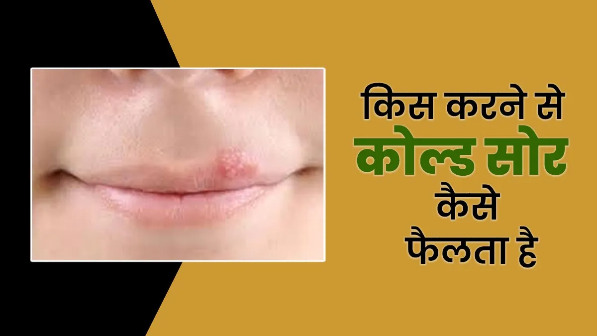 पार्टनर के साथ किसिंग से फैल सकता है वायरल इंफेक्शन कोल्ड सोर, इन 5 टिप्स से करें बचाव
