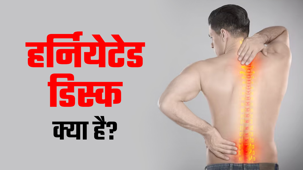 हर्नियेटेड डिस्क (स्‍पाइन नस पर दबाव) क्‍या है? डॉक्‍टर से जानें लक्षण, कारण और इलाज