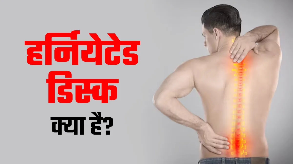 हर्नियेटेड डिस्क (स्‍पाइन नस पर दबाव) क्‍या है? डॉक्‍टर से जानें लक्षण, कारण और इलाज