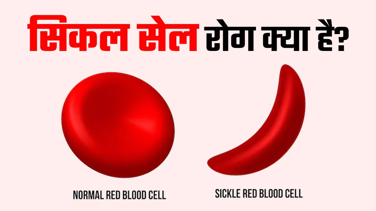 2.15 लाख लोगों को है सिकल सेल रोग: स्‍वास्‍थ्‍य मंत्रालय, जानें इसके दुष्‍प्रभाव, र‍िस्‍क फैक्‍टर्स