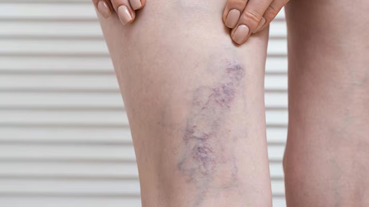 Can sitting with legs folded cause varicose veins hindi