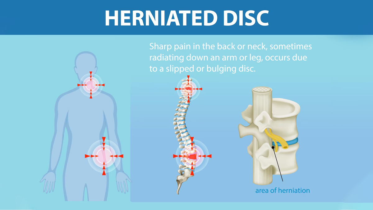 Herniated-disc-symptoms-causes-treatment