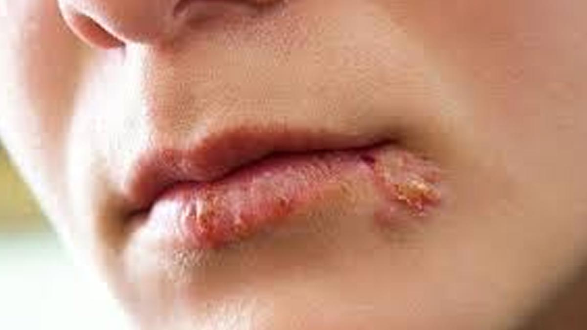 किस करने से कोल्ड सोर कैसे फैलता है | Can Cold Sores Be Transmitted Through Kissing in hindi   cold-sor-inside