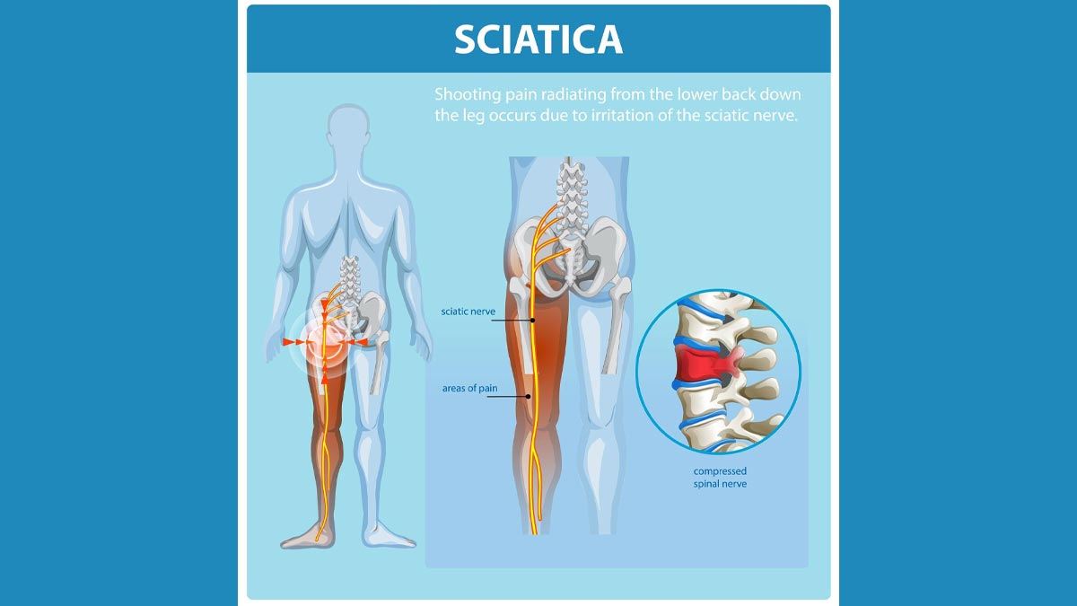 sciatica-back-pain-difference