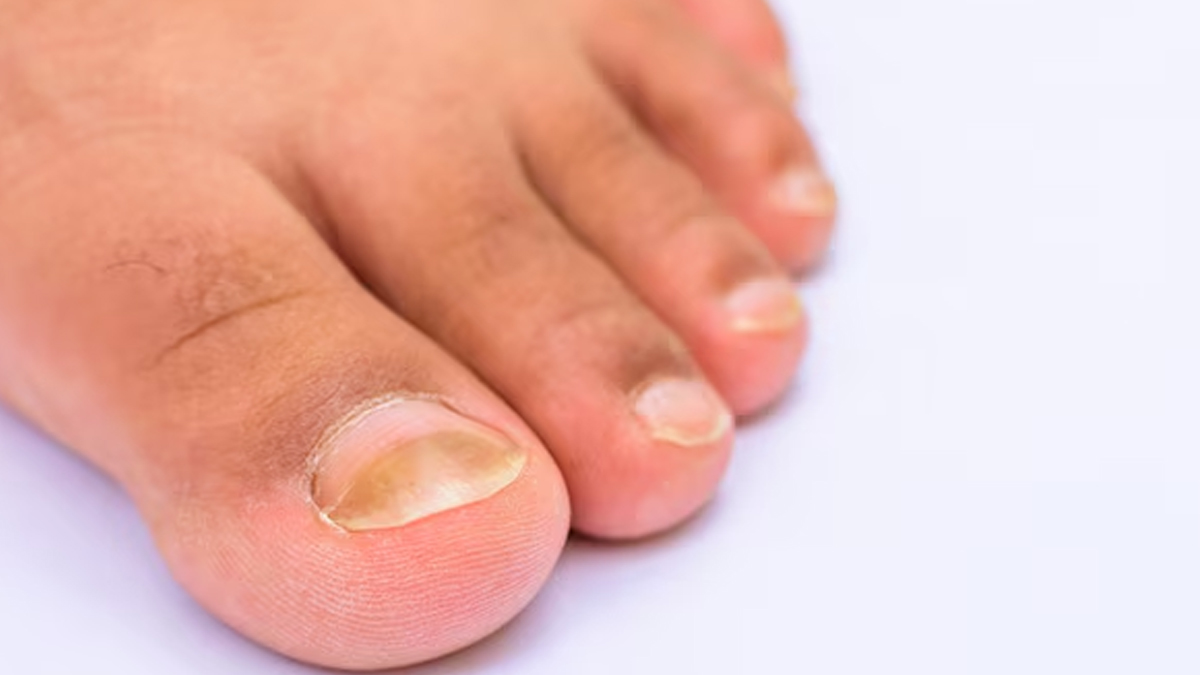 Changing color of toenails can be a sign of heart disease hindi