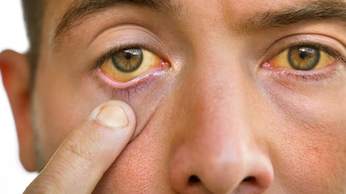 how to reduce jaundice